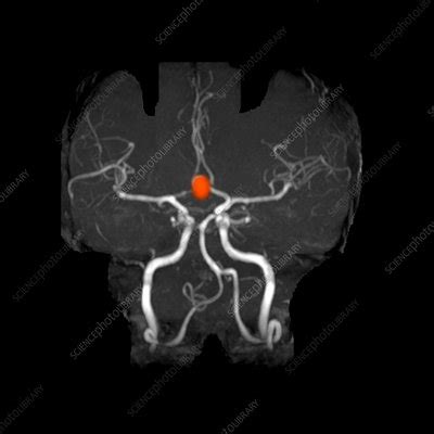 Anterior Communicating Artery Aneurysm - Stock Image - C003/4630 ...