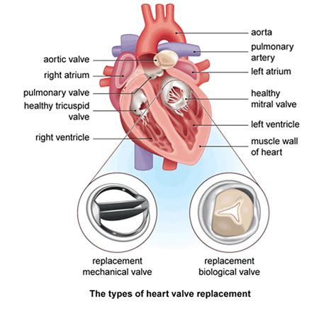 Heart Surgery Types - Open, Bypass, Ablation, Heart Valve surgery