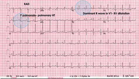 The ECG's of Pulmonary Embolism - Resus