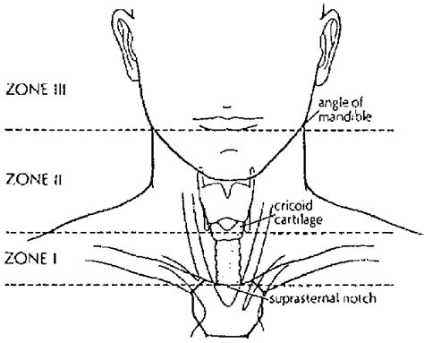 Definition of the three anatomic zones used in neck trauma (from ...