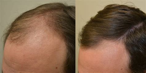 Finasteride Before and After Photos [2022]