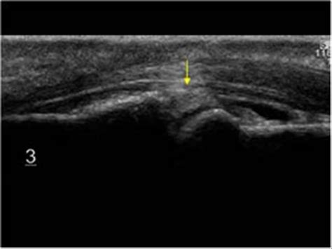 Musculoskeletal Joints and Tendons | 6.4 Fingers : Case 6.4.8 Other ...