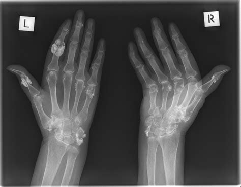 Scleroderma Hands Xray