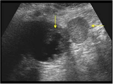 Abdomen and retroperitoneum | 1.4 Spleen : Case 1.4.3 Splenic infarcts ...