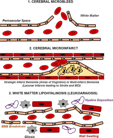 Vascular lesions in small vessel disease. Key types of vascular lesions ...