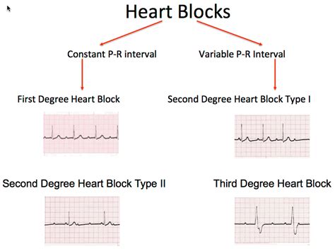 Heart Block Types Ecg