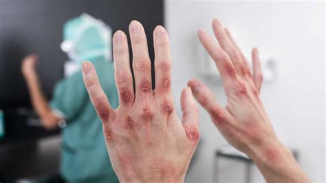 Contact dermatitis | Mölnlycke