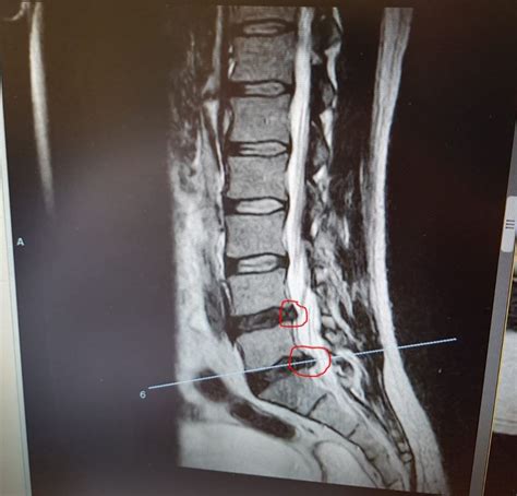 List 100+ Images Mri Images Of Herniated Disc L5-s1 Updated