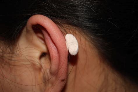 Ear Keloids - Ear Helix Keloid