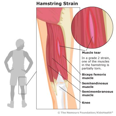 Hamstring Strain (for Teens) - Humana - Louisiana