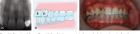 Figure 12 from Esthetic considerations in interdental papilla ...