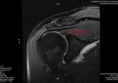 Diagnosis: Glenoid Labral Tear | POGO Physio Gold Coast