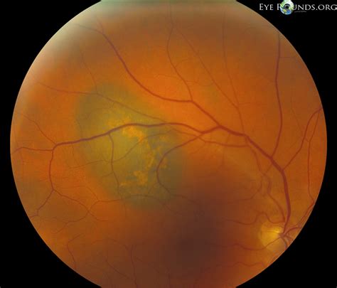 Choroidal malignant melanoma with orange pigment: Online Atlas of ...