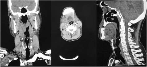 Coronal and sagittal tomography view of omegashaped epiglottis. Axial ...