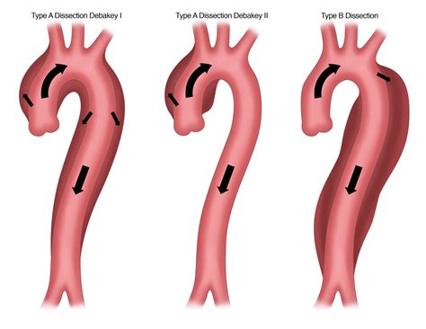 Thoracic Aortic Dissection Causes Symptoms And Diagnosis | Porn Sex Picture