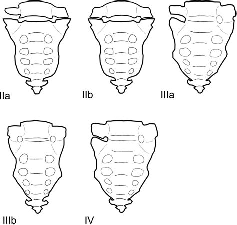 Optimum Vertebral Level of Castellvi Type III or Higher Lumbosacral ...