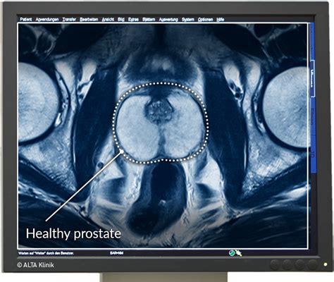 Multiparametric MRI of the Prostate - ALTA Klinik