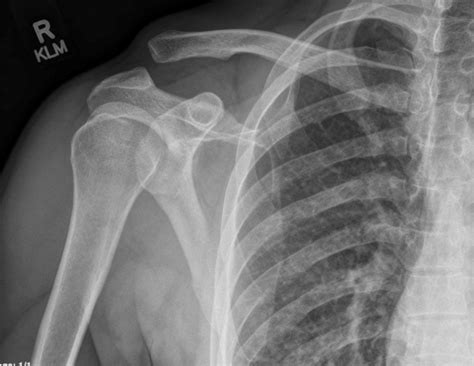 Acromioclavicular Joint Separation – Undergraduate Diagnostic Imaging ...