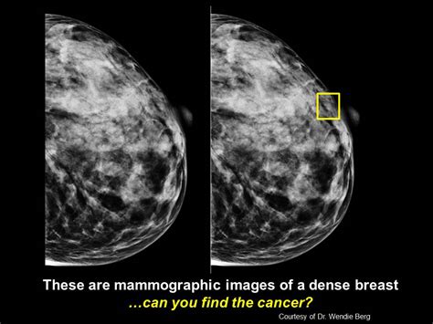 Knowing Your Breast Density Can Save Your Life | HERS Magazine