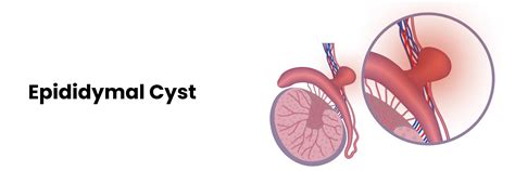 Epididymal Cyst: Symptoms, Diagnosis and Treatments