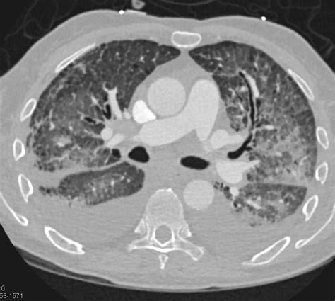 Pulmonary Edema in Patient with Interstitial Lung Disease - Chest Case ...