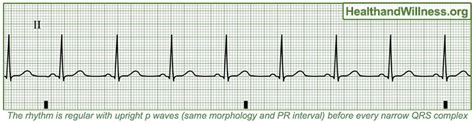 ECG: Basic Interpretation Jeopardy Template