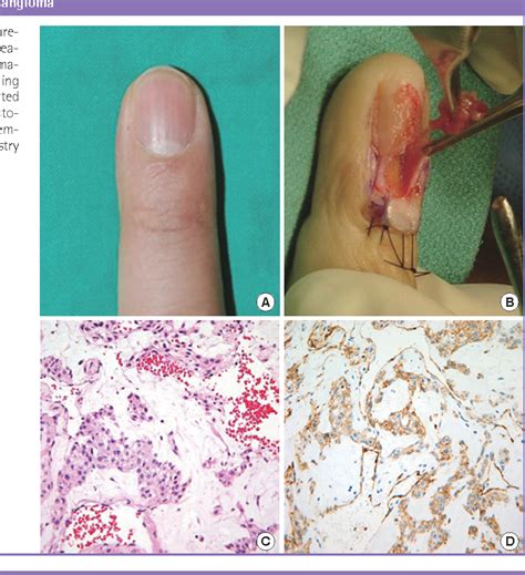 [PDF] Glomus Tumor of the Hand | Semantic Scholar