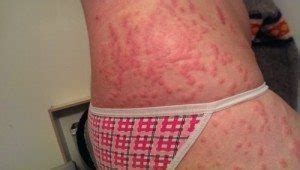 PUPPP Rash and How to Treat It - Twiniversity