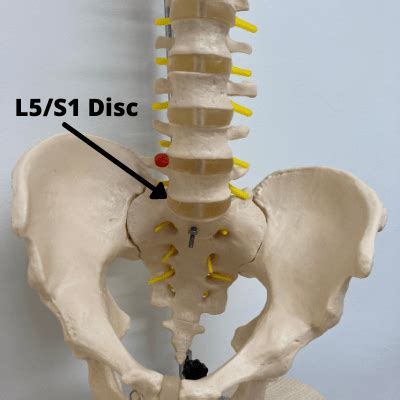 L5/S1 Nerve Root Compression Symptoms and Treatment (2023 Complete Guide)