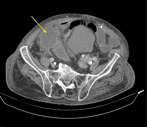 Spontaneous Gallbladder Perforation: A Case Report | Cureus