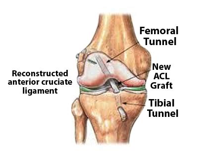 Acl repair - lockqwinter