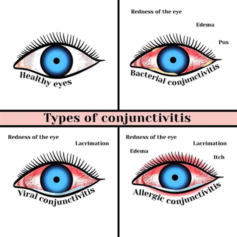 Viral Eye Infection: Types, Symptoms, Treatment | STD.GOV Blog