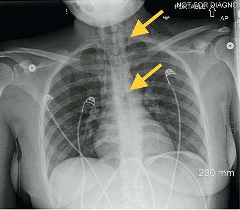 Cureus | Prolonged Emesis Causing Esophageal Perforation: A Case Report