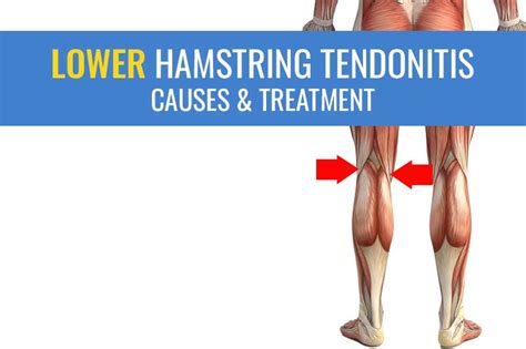 Lower hamstring tendonitis – Causes, symptoms, treatment, and recovery ...