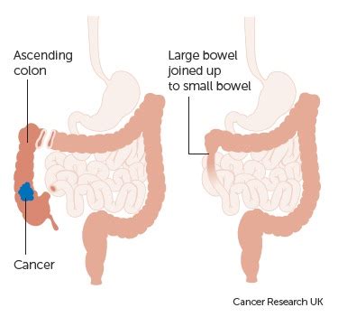 Colectomy - The Operative Review Of Surgery