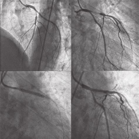 Treatment of in-stent restenosis. (A and B) Diffuse in-stent restenosis ...