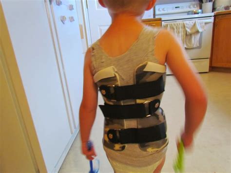 Our Journey through Progressive Infantile Scoliosis: pictures of brace