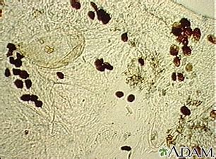 HIE Multimedia - Scabies mite - photomicrograph of the stool