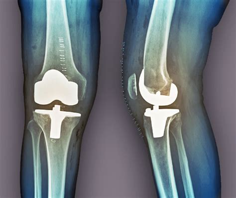 Partial vs. Total Knee Replacement Surgery