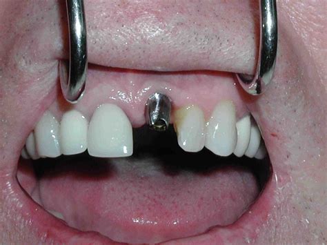 What is a dental implant abutment - Dental News Network