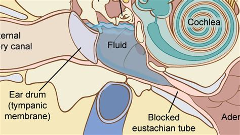 How To Reduce Fluid In The Ear - Tomrelation7