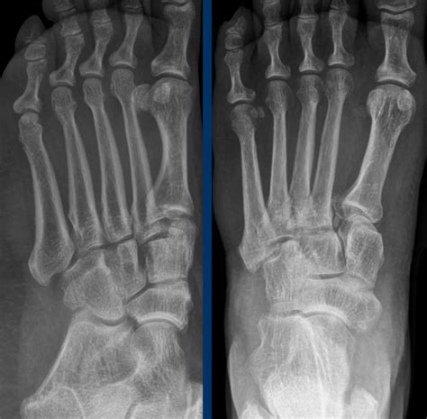 The Radiology Assistant : Foot and Ankle cases