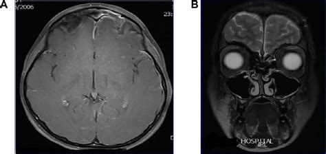 (A) MRI showing frontal sinusitis with meningitis and sagittal sinus ...