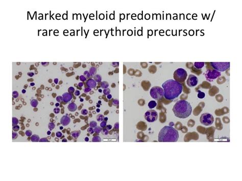 Diamond Blackfan Anemia Aspirate