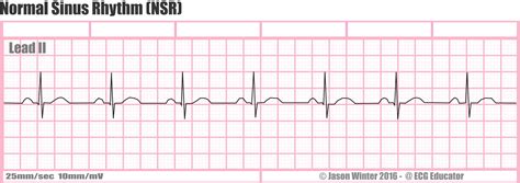 ECG Educator Blog : Normal Sinus Rhythm