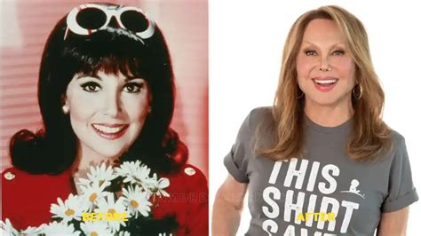 Marlo Thomas Plastic Surgery, Facelift, Nose Job, And Before-After ...