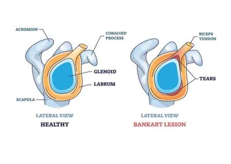 Bankart Repair | Orthopedic Shoulder Doctor | Vail, Aspen, Colorado ...