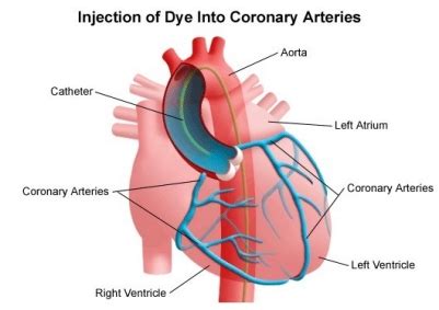 Types of Cardiac Catheterization | Stanford Health Care