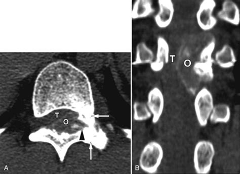 Osteoblastoma | Radiology Key