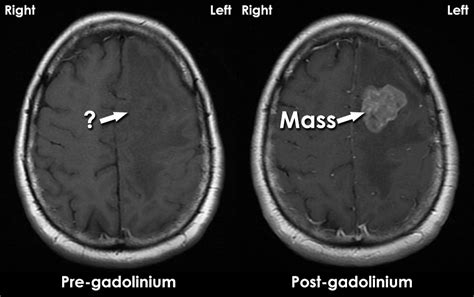 Is It Safe To Be In The Mri Room - Printable Online